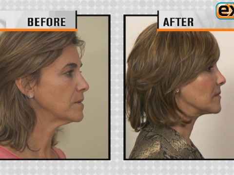 New Facelift Technique for Faces Over 50!